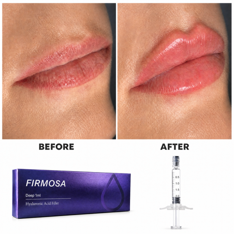 Korea Lip Filler Hyaluronic Acid Lip Fillers for Natural Lip Enhancement